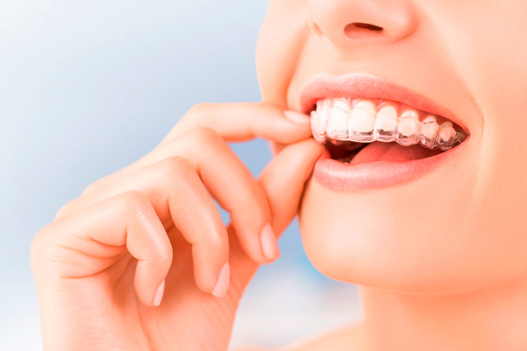 ortodoncia_invisible